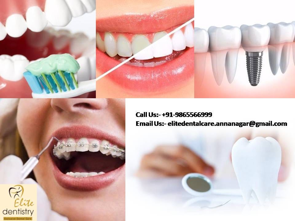 Easy Steps To composite fillings Blue Springs Of Your Dreams