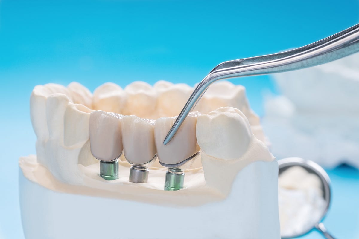 Why Dental Implants Are So Expensive by Dentist Gosford Medium