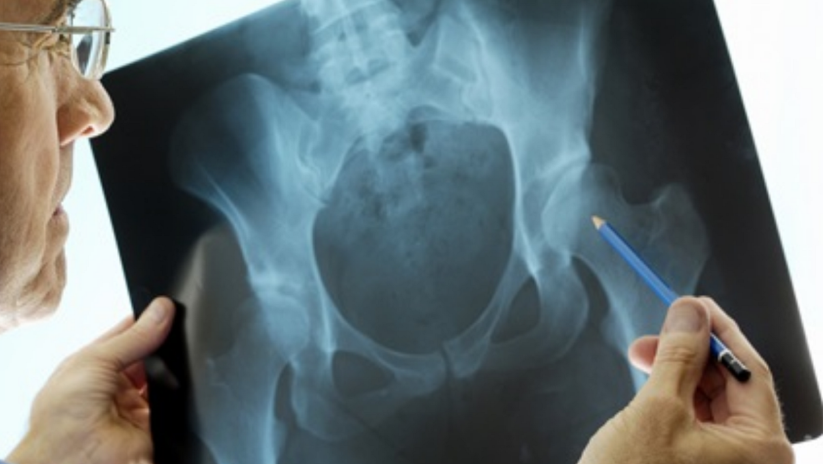 Is Hip Reconstruction and Hip Replacement the Same? by bestOrthopedic treatment Medium