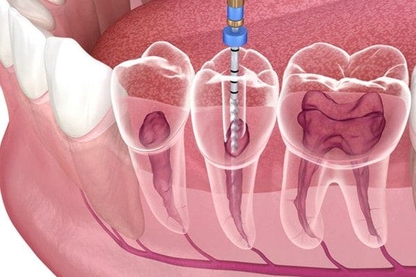 Endodontic Treatment in solapur