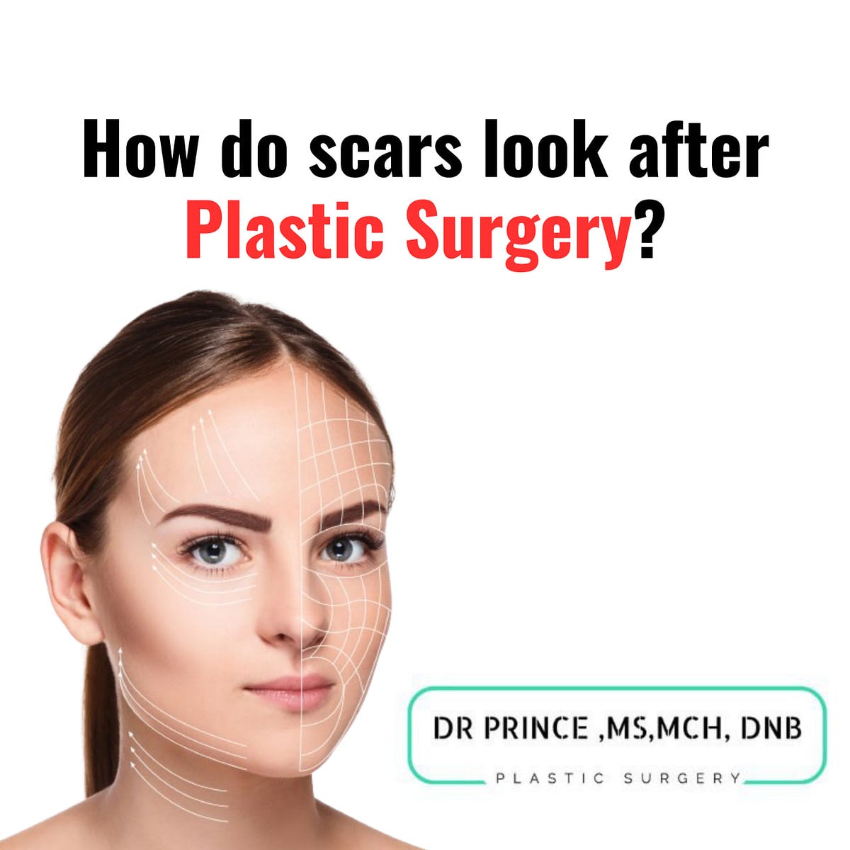 How do scars look after Plastic Surgery? by SIRAJUL MUNEER Dec
