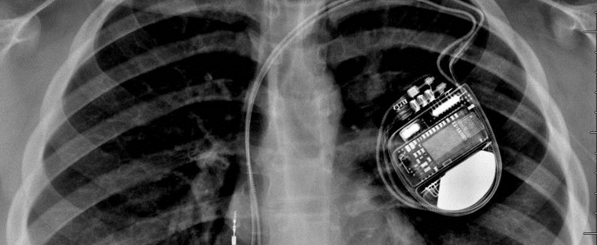Pacemaker 101. I haven't been apart of the medical… | by Tiffany