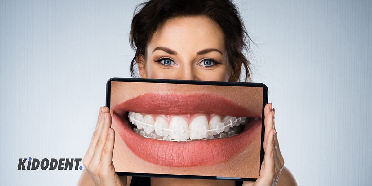 ceramic braces vs metal braces what is the difference