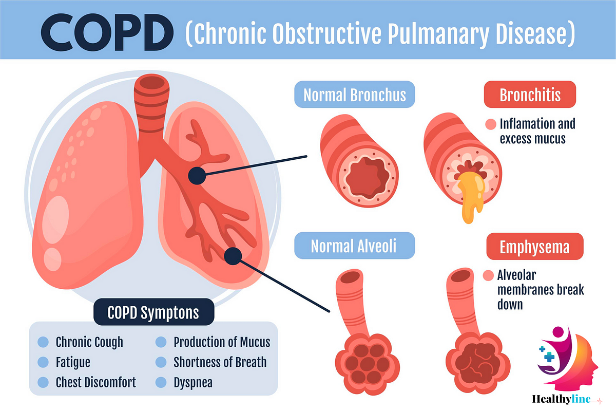 COPD: Understanding, Treating, and Coping with a Chronic Obstructive ...