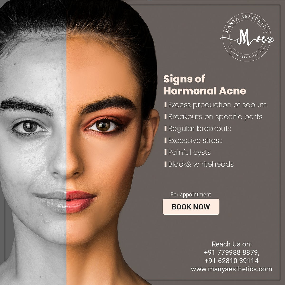 Acne Scar Treatment in Hyderabad Manya Aesthetics by manyaaestheticclinic Medium