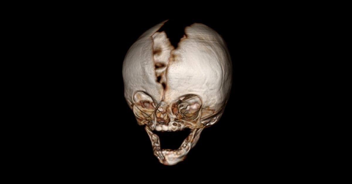 Skull Surprise  Harvard Medical School