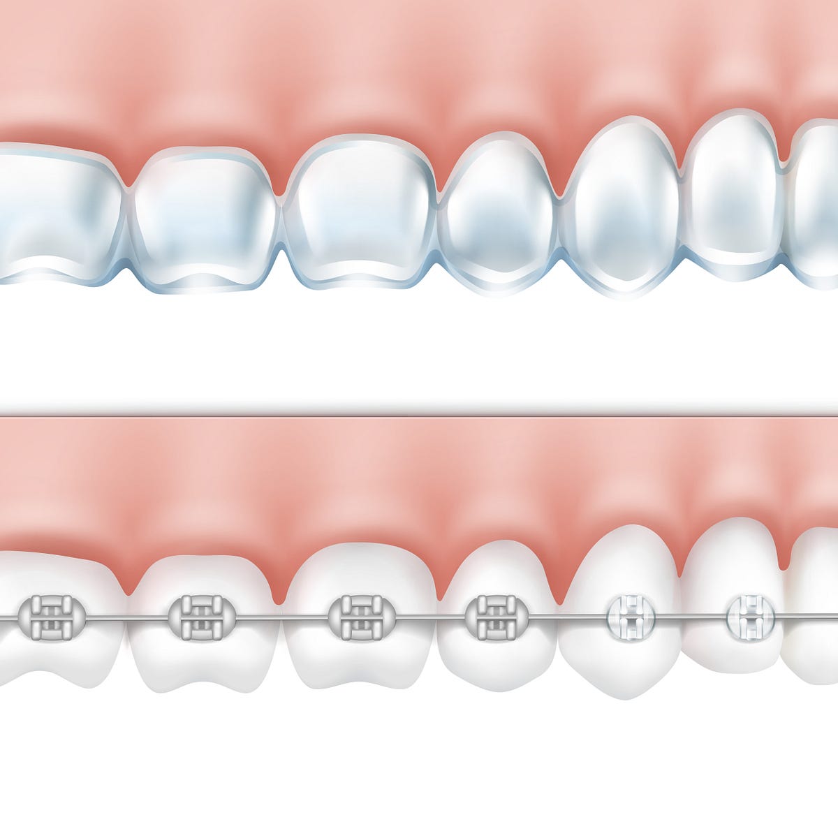 6 Points That Helps You Choose Between Clear Braces and Invisalign