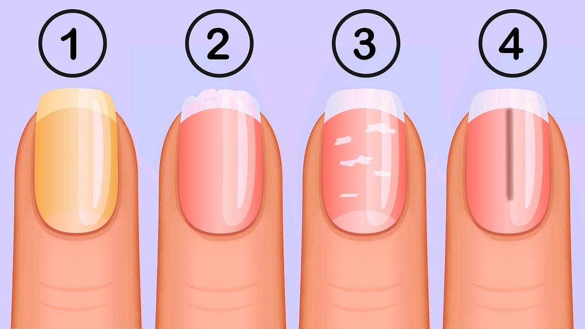 8 Nail Conditions and What They Mean for Your Health | Nail conditions,  Lines on nails, Nail health