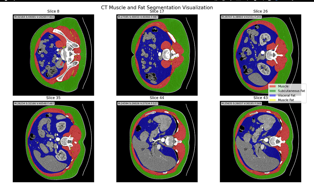 How AI Reads CT Scans to Measure Body Composition | by Nandini Lokesh ...