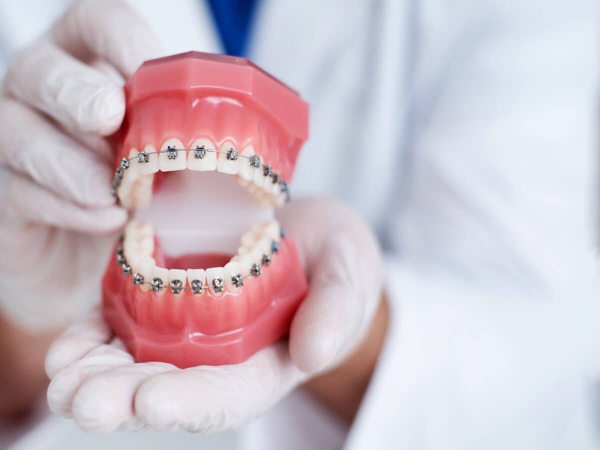 Understanding Orthodontic Treatment How Many Teeth Are Removed for Braces by Bilal Randhawa