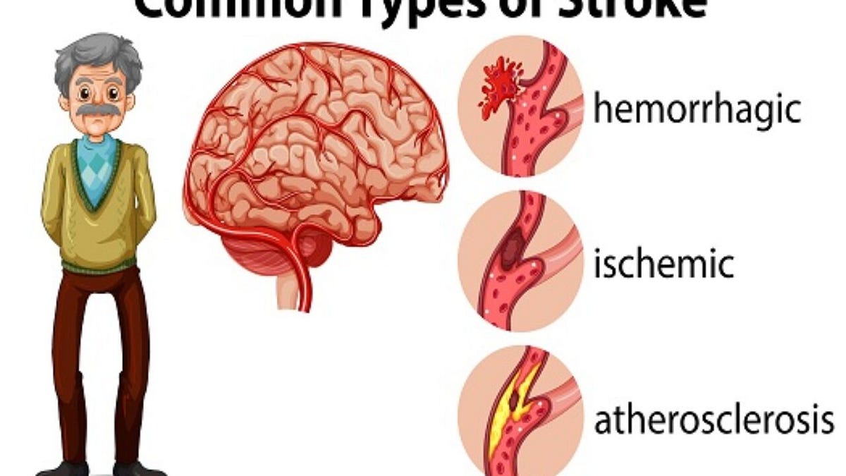 what-are-the-3-different-type-of-stroke-by-dr-amit-shah
