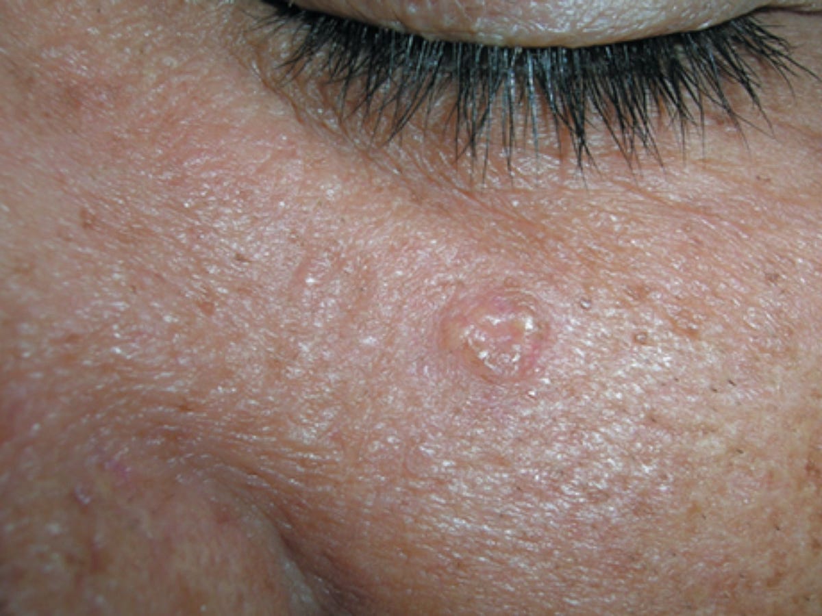 What Is Sebaceous Hyperplasia?. Sebaceous hyperplasia is a typical skin