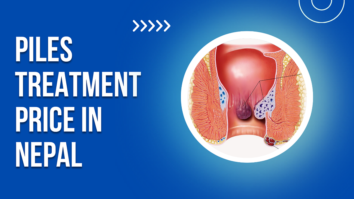 Piles Surgery Cost in Nepal Affordable Pricing by Ram Pandey Apr