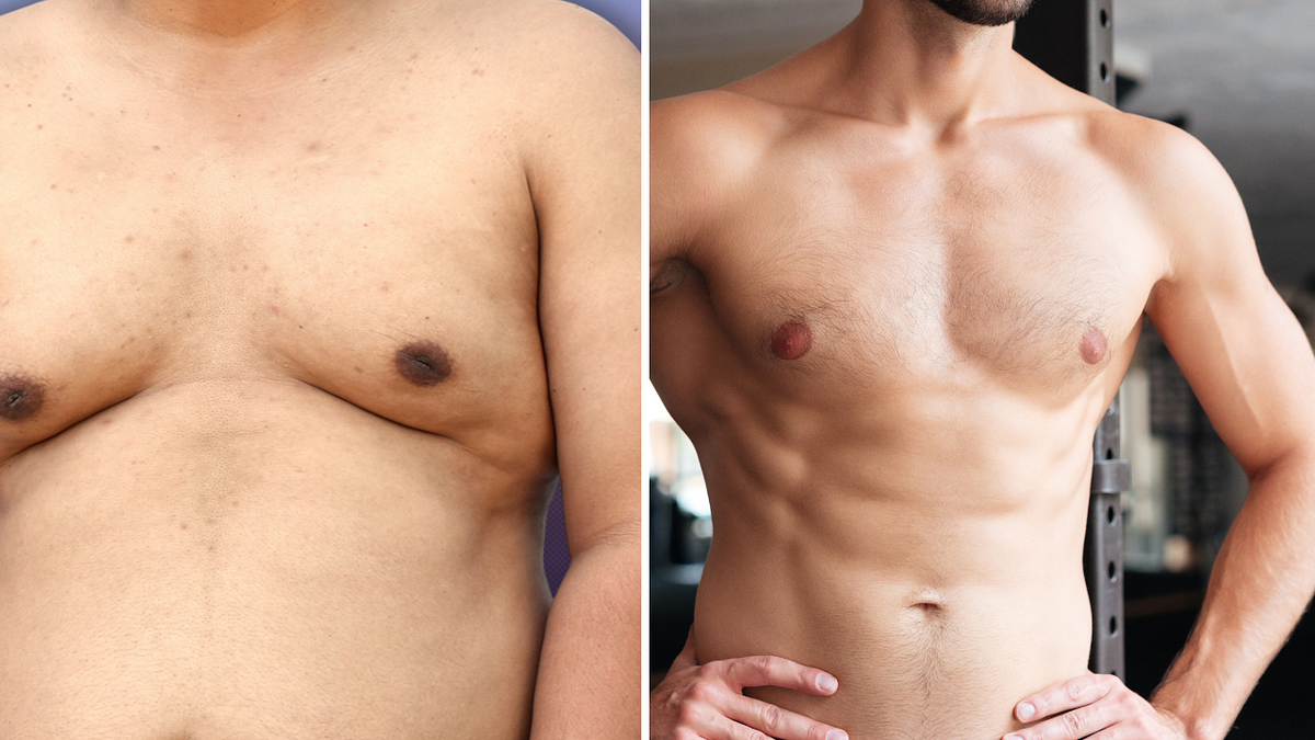 What Can Men Do About Sagging Pecs or Breasts? - NuBody Concepts