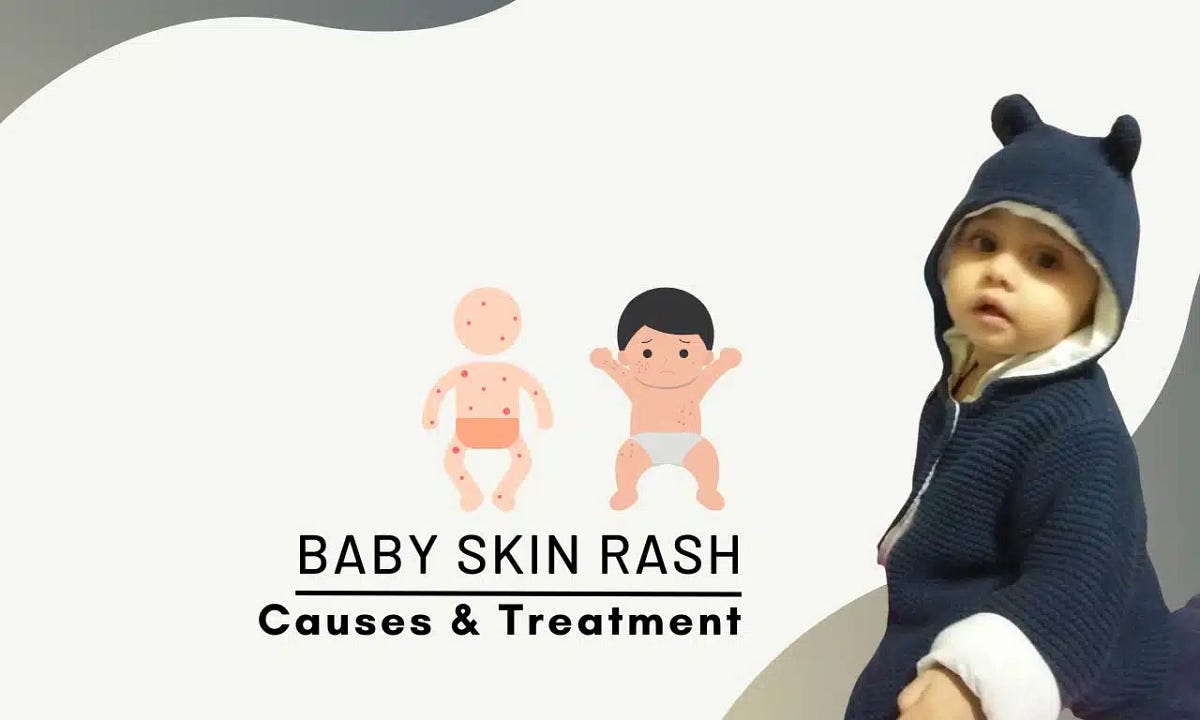How to Choose the Best Cream for Rashes and Itchy Skin in Babies