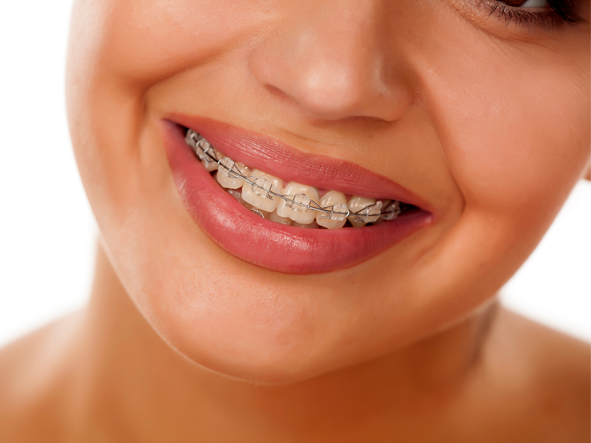 Clear Braces in NYC. People can get many different types of… by House