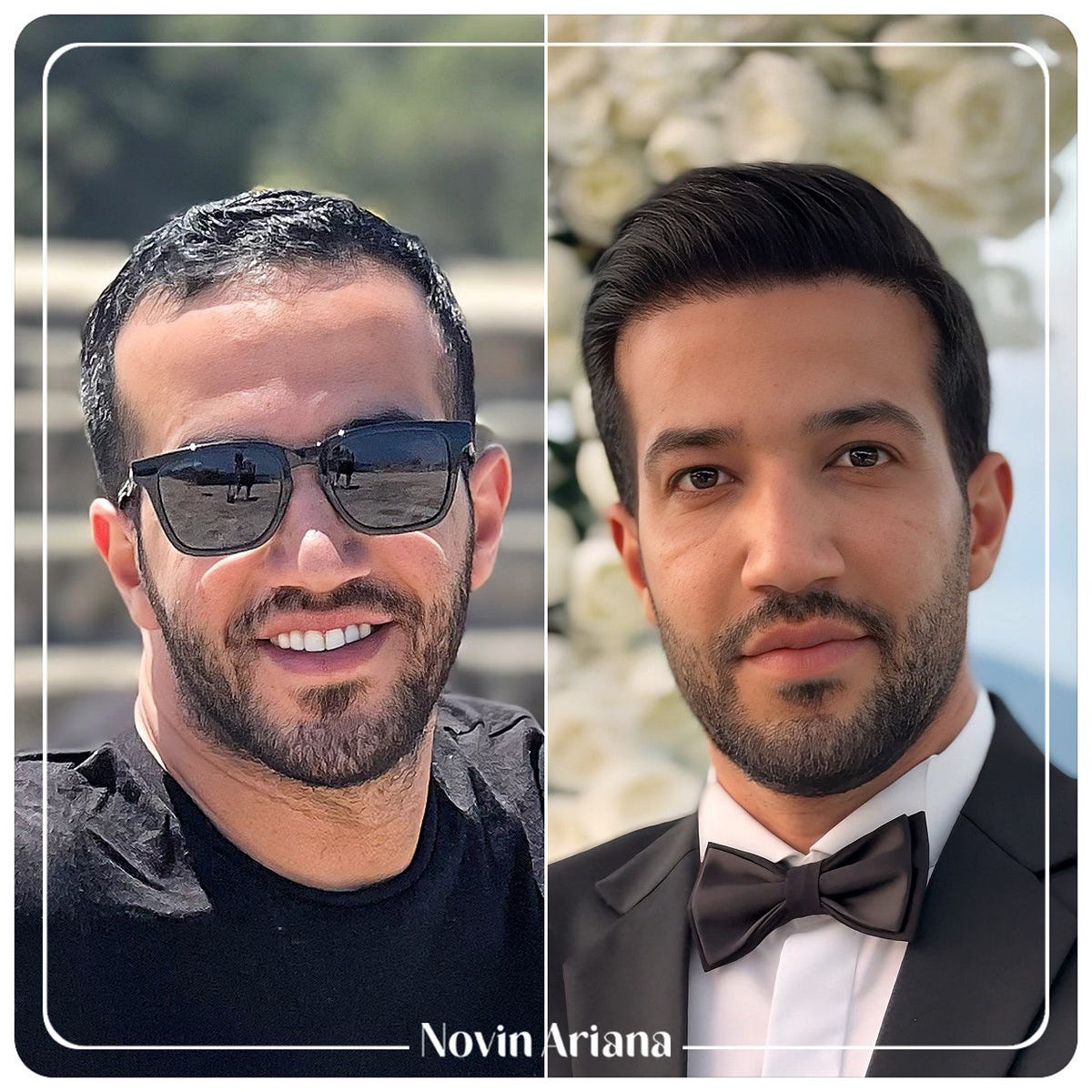 3 month after hair transplant. 3 month after a hair transplant, you