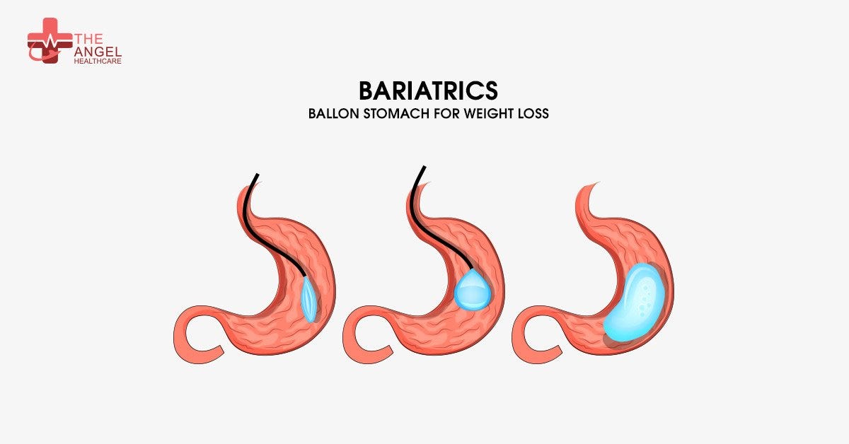 Know All About Bariatric Weight Loss Surgery by TahGlobal Medium