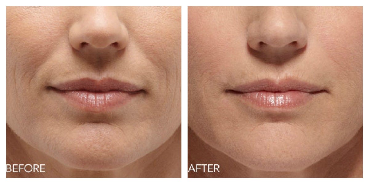 FILLERS FOR WRINKLES AROUND MOUTH by WrinklePedia Medium
