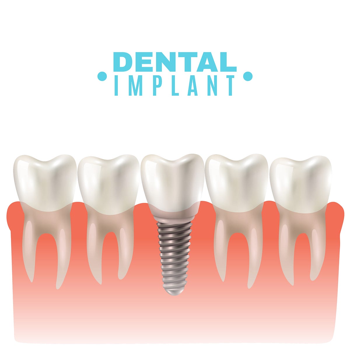 Dental Implants and Bone Health How Implants Preserve Jawbone Density