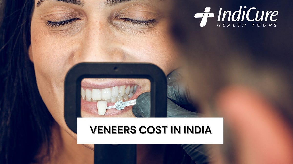 Veneers Cost in India Procedure, Costs, Life, and More by IndiCure