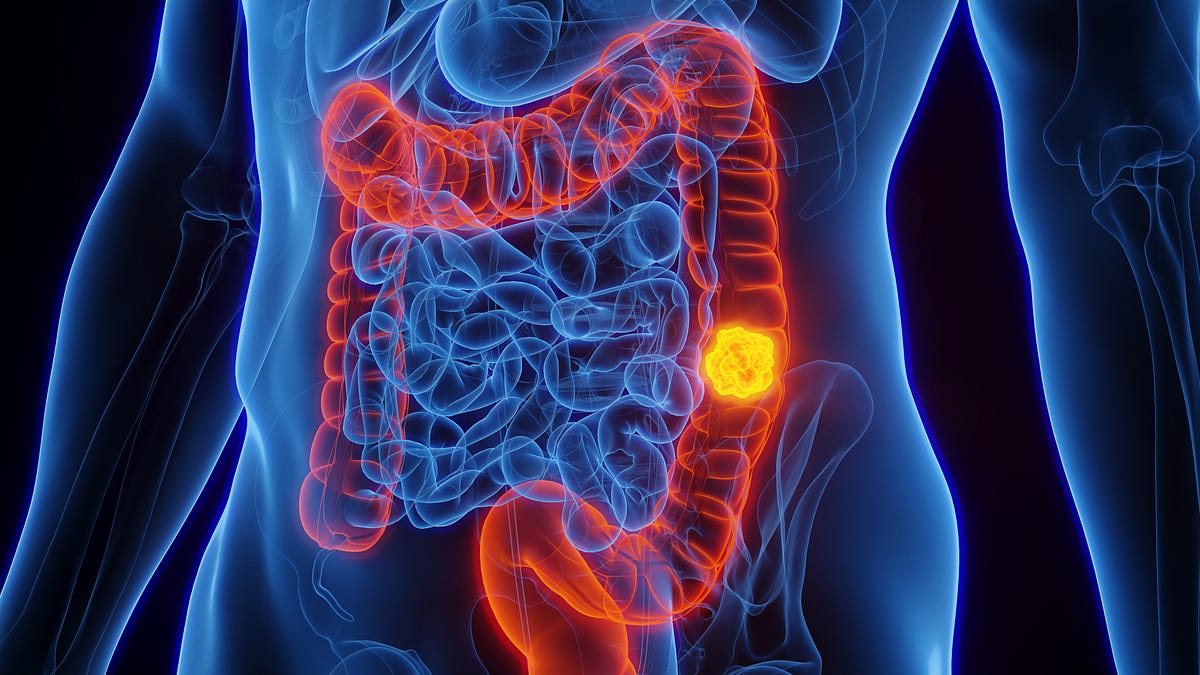 Unexpected Signs of Colorectal Cancer Paying Attention to Thin Stools
