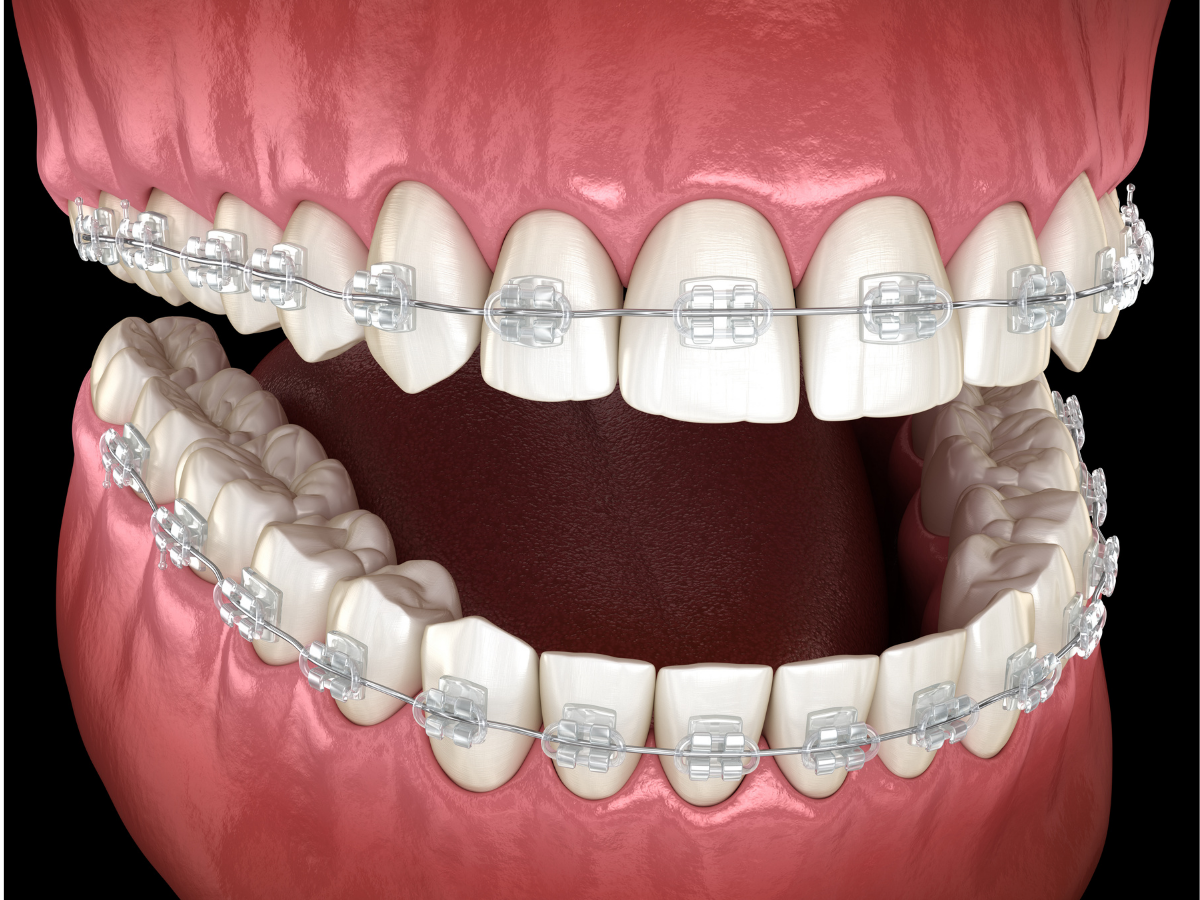 Clear Ceramic Braces in Coral Springs by Orthodonticsjohn Medium