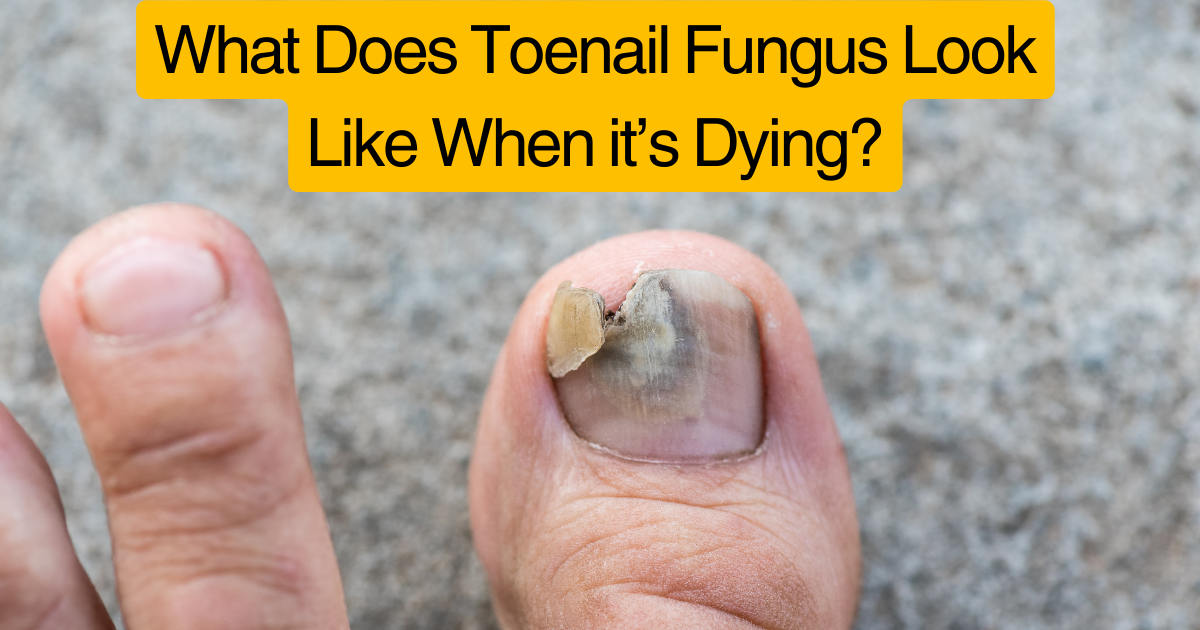 What Does Toenail Fungus Look Like When it’s Dying? Medium