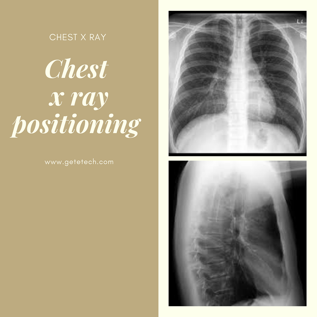 chest x ray erect pa projection and erect lateral procedure by pagan