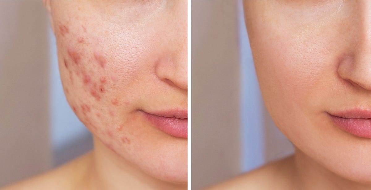 My Journey to Clear Skin How “My Pimple Cream” Worked Miracles for My
