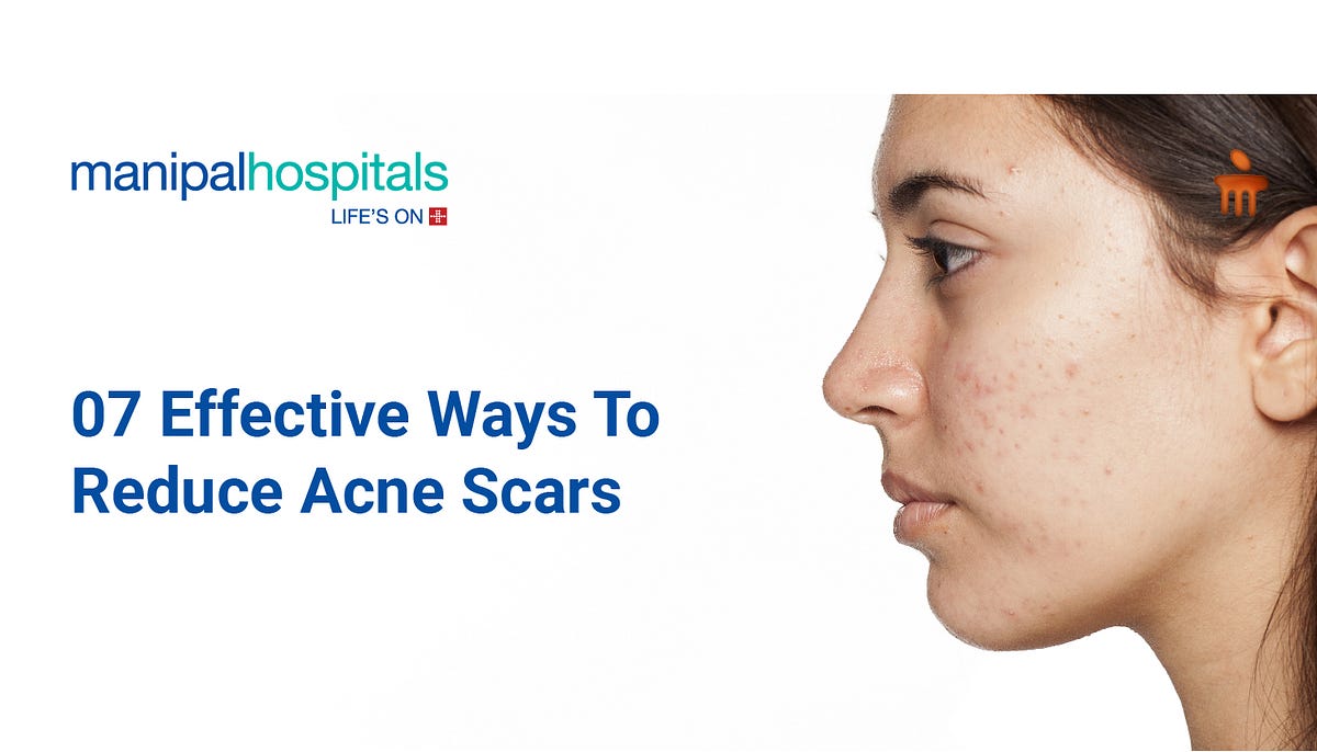 From Blemishes to Beauty: A Comprehensive Guide to Reduce Acne Scars 