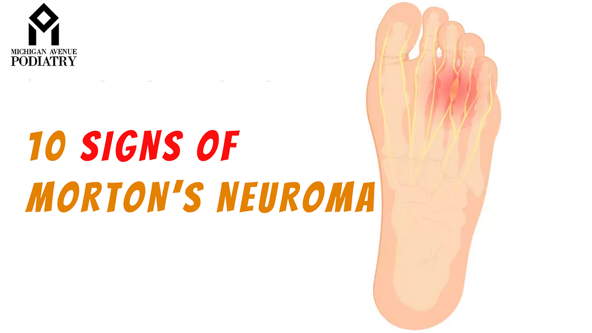 10 Signs You May Have Morton’s Neuroma | Medium