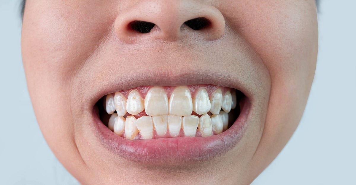 Have White Spots On Your Teeth Fortunately There s A Solution By have-white-spots-on-your-teeth-fortunately-there-s-a-solution-by