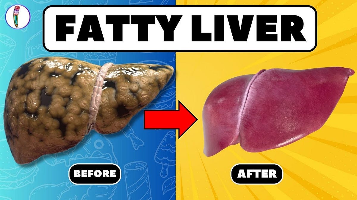 Strictly Avoid These 5 Foods if You Have Fatty Liver Fatty Liver