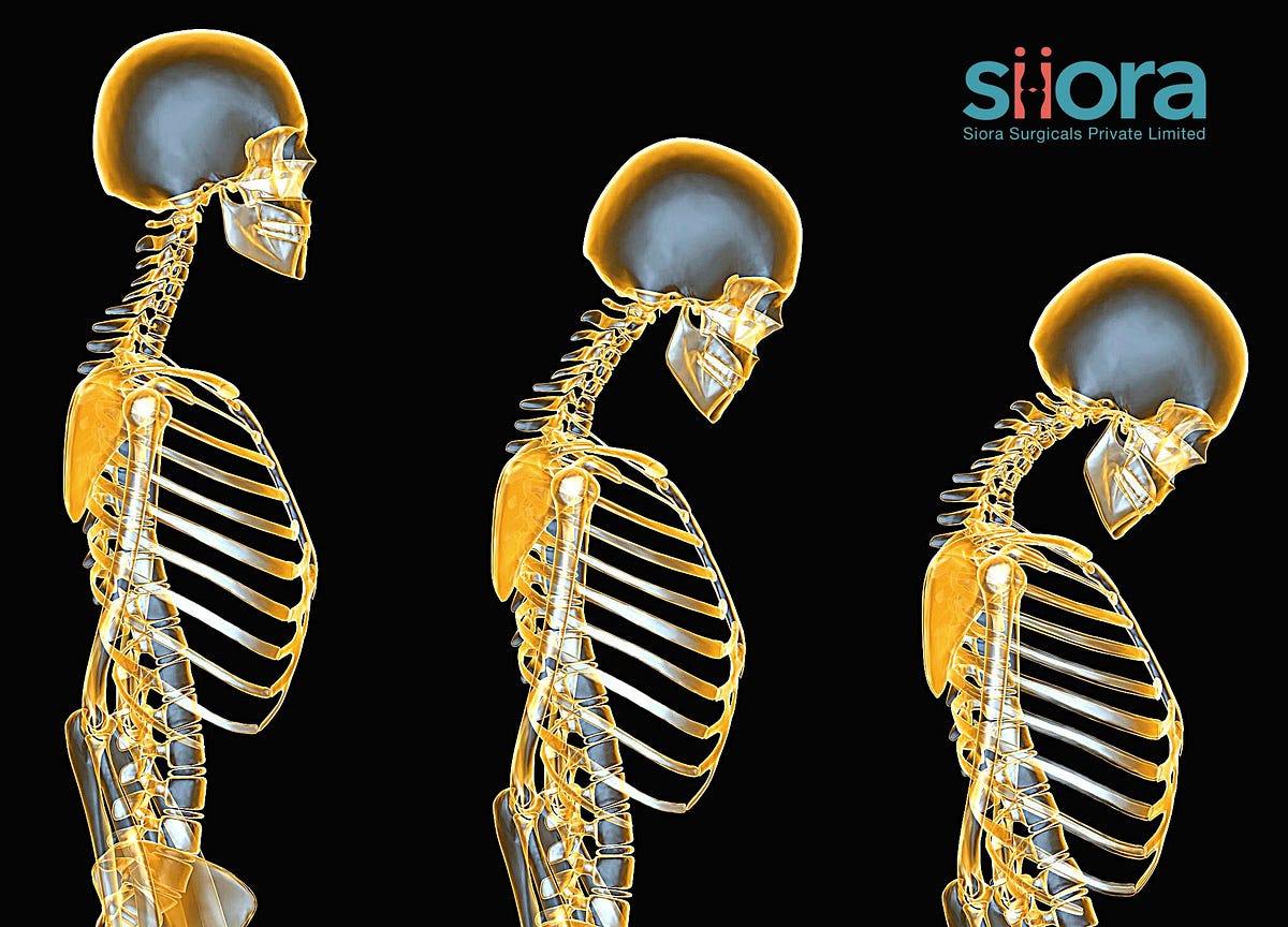Progression of Osteopenia to Osteoporosis — What You Should Know ...