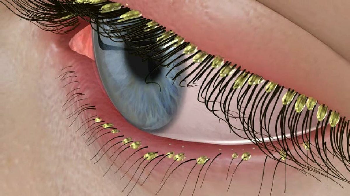 Eyes Under Siege: Demodex Blepharitis Explained | by giya | Sep, 2023 ...