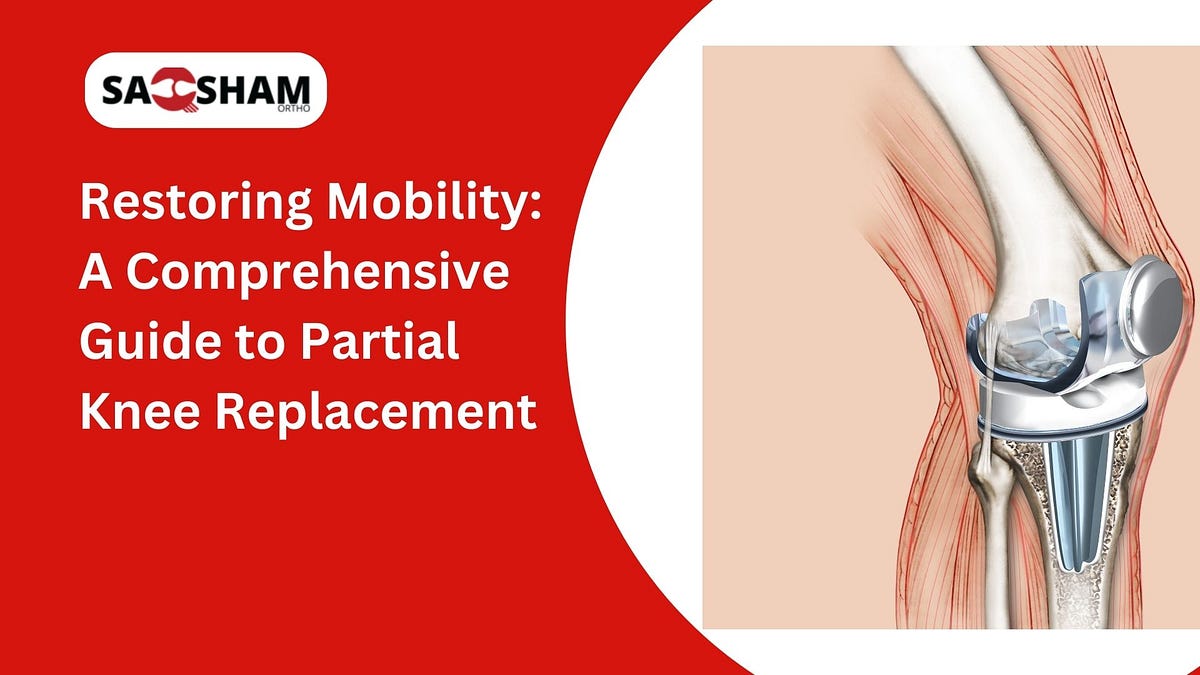 Restoring Mobility A Comprehensive Guide to Partial Knee Replacement