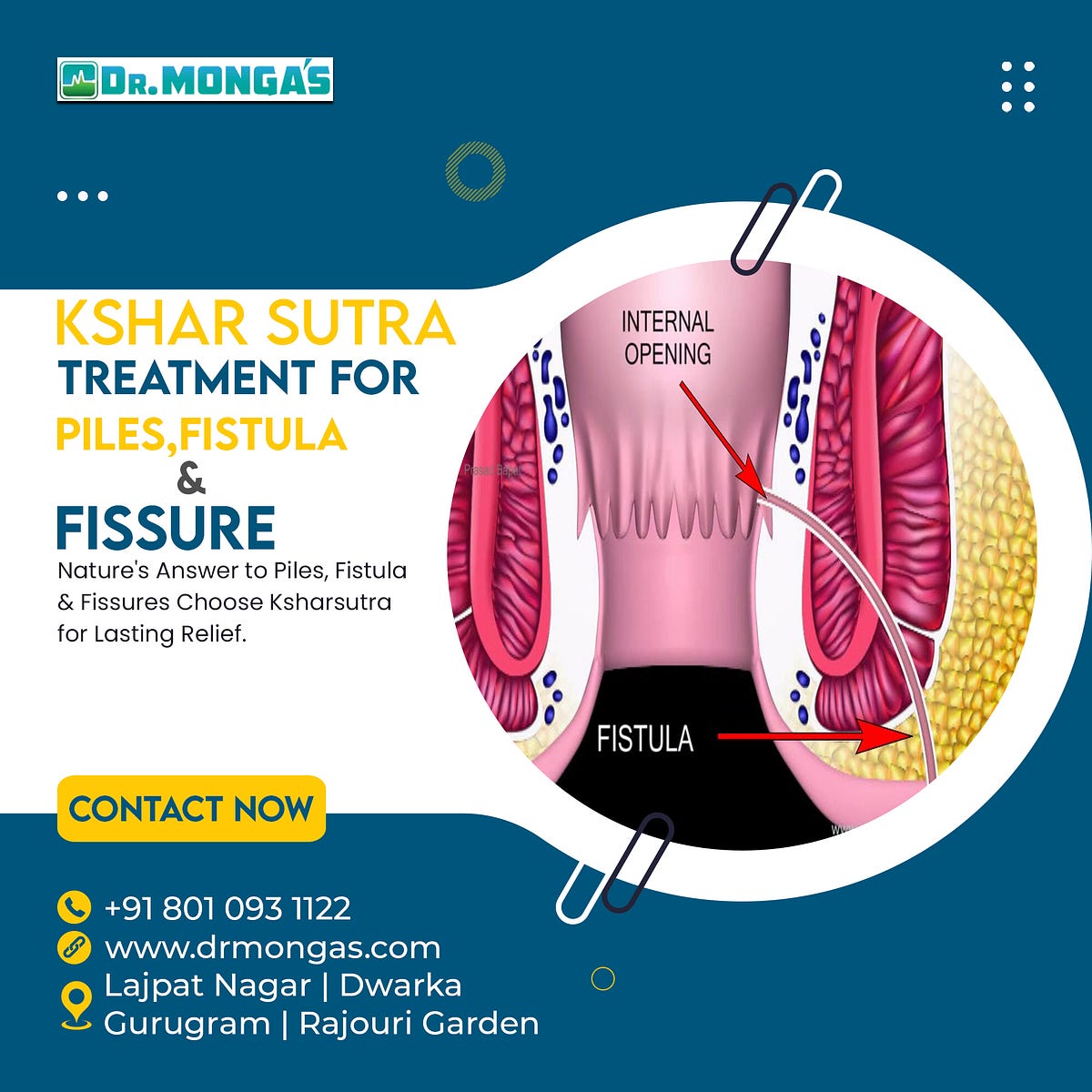 Kshar Sutra Treatment for Piles, Fissure, and Fistula by Dr. Jyoti