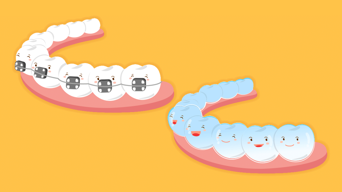Braces V/s Invisalign: Which is better for me? | by ...