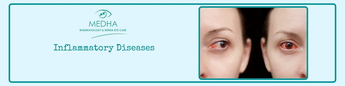 Inflammation Of The Eye Symptoms Causes And Treatment Inflammatory