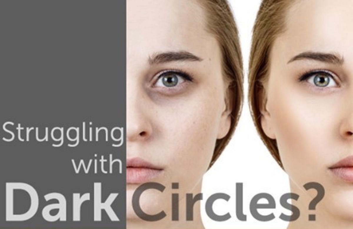 Dealing with Dark Circles Around the Eyes by Pierre Lerena Medium