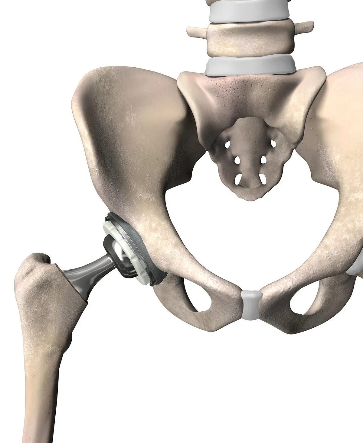 The Current Role Of Robotics In Total Hip Arthroplasty by Team Ortho Robotics Nov, 2023 Medium