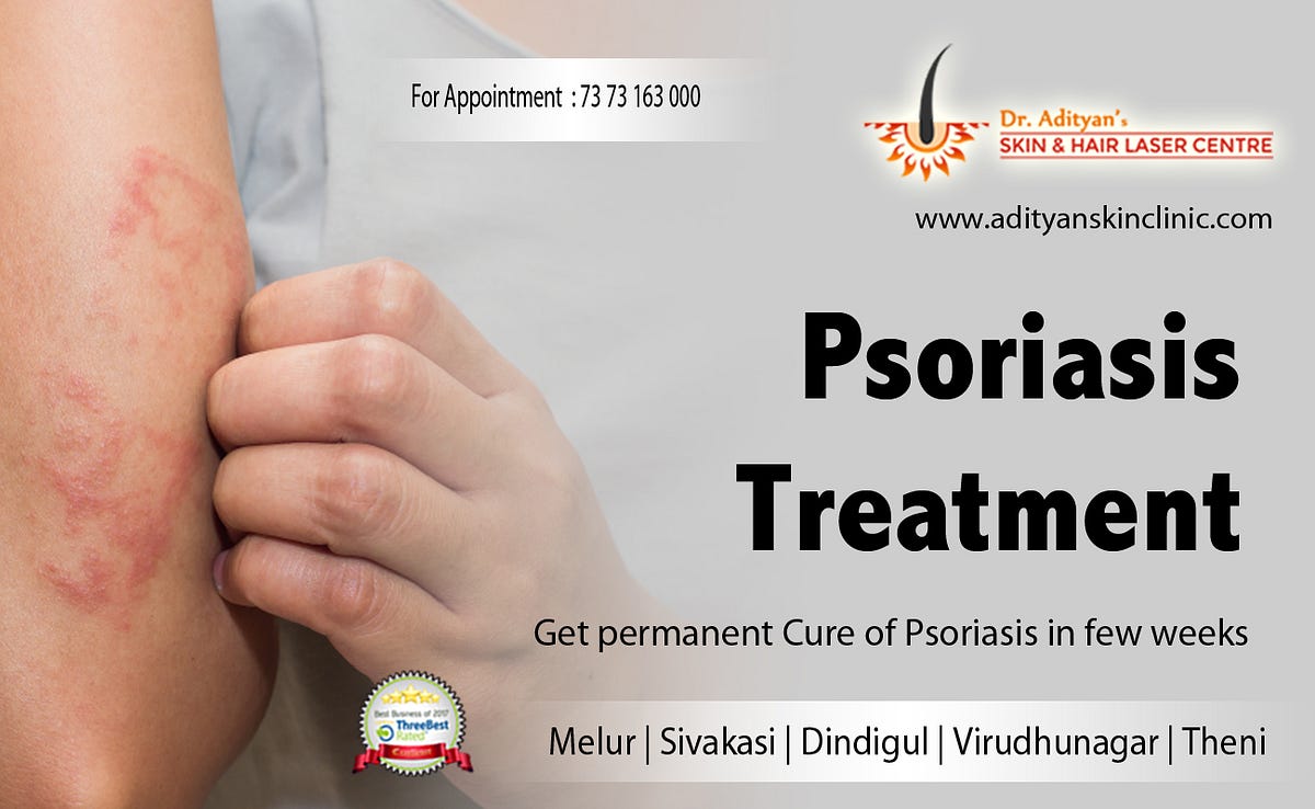 How can psoriasis flareups be prevented? by harrisonwillies Medium