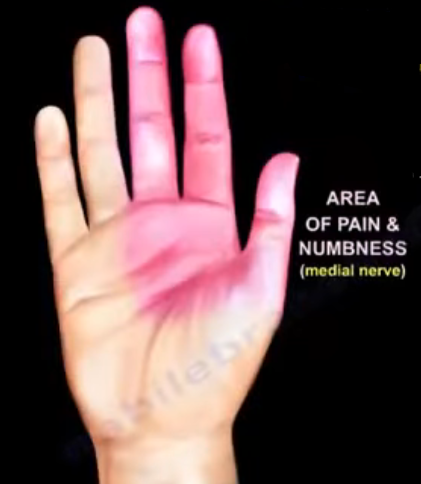 Why Your Hand Goes Numb at Night Understanding Positional Nerve