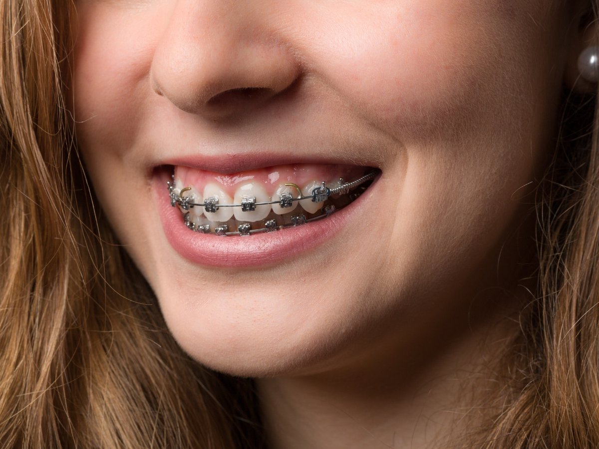 Metal Braces in Boca Raton Transforming Smiles with Traditional