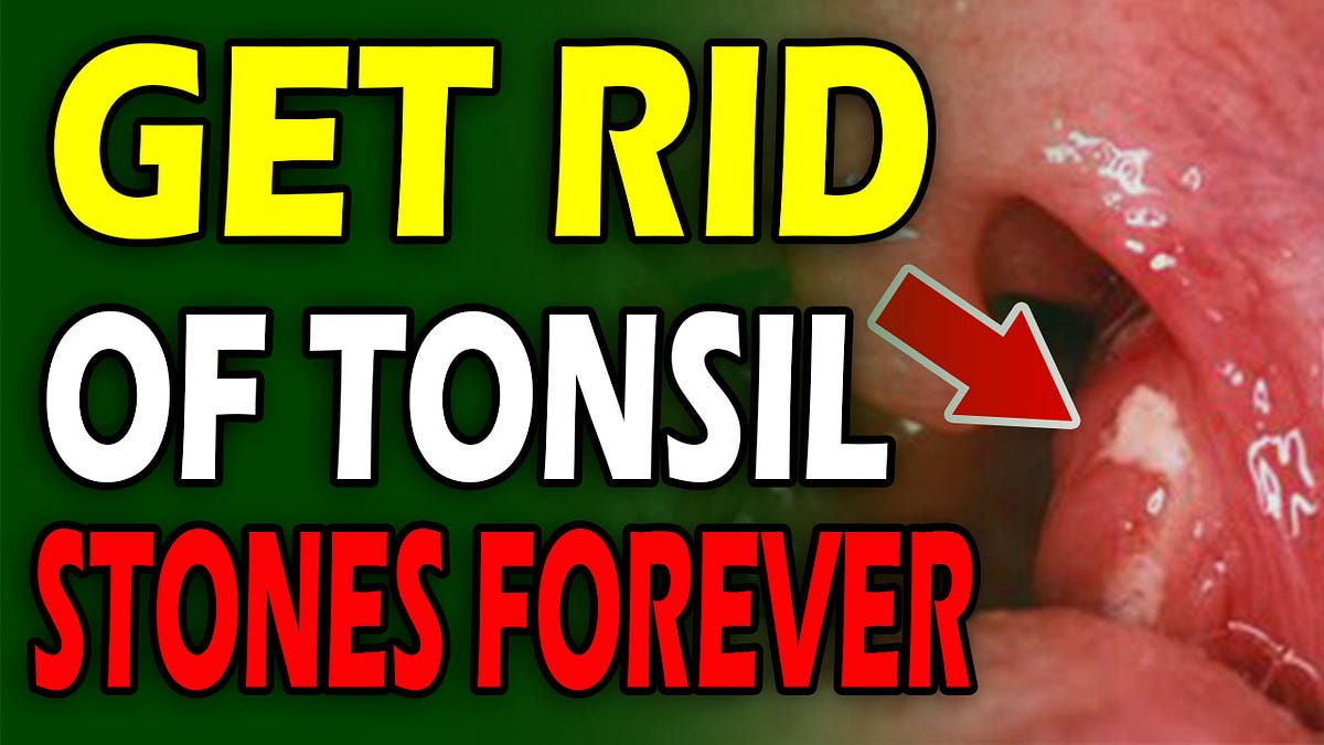 The Simplest Way to Remove Tonsil Stones by Elizabeth Kingsley Medium