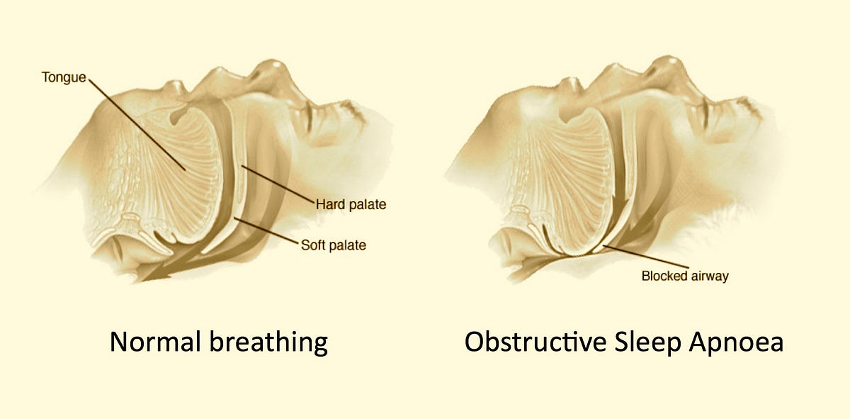 Shake, Rattle and Snore. Obstructive sleep apnoea — the ‘hidden’… by