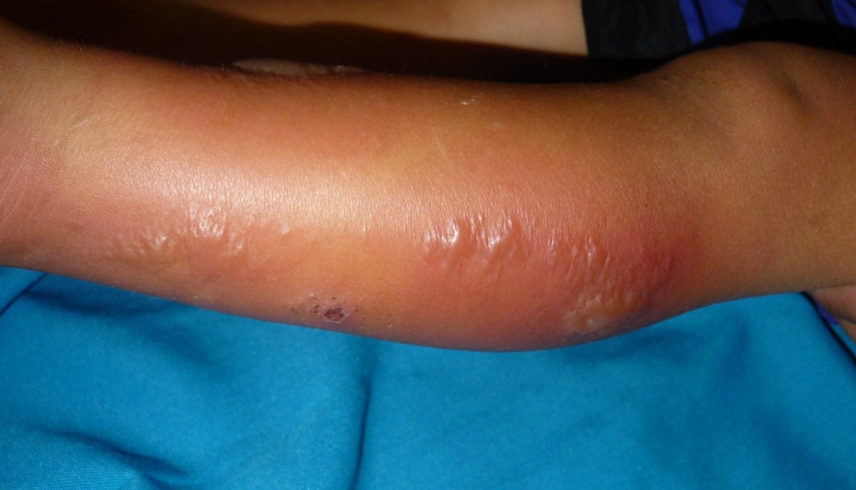 allergy-symptoms-and-treatment-allergies-are-a-common-condition-that