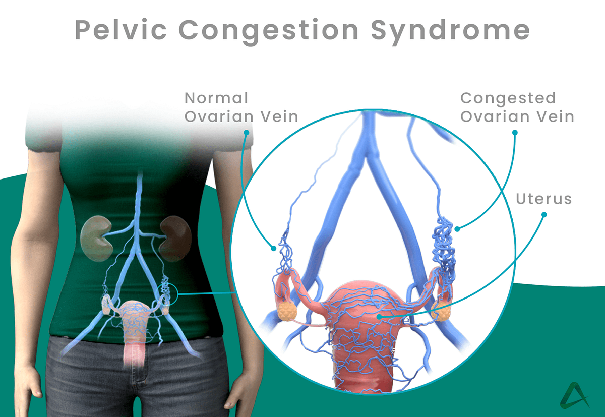 Gorgeous Can Pelvic Congestion Syndrome Cause Dizzy Spells Landscape in 4K Gorgeous Can Pelvic Congestion Syndrome Cause Dizzy Spells Landscape in 4K