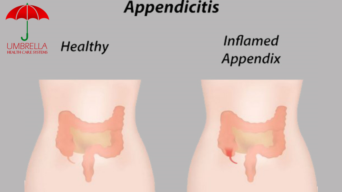 What Are The Causes Of Appendicitis? Symptoms & Treatment